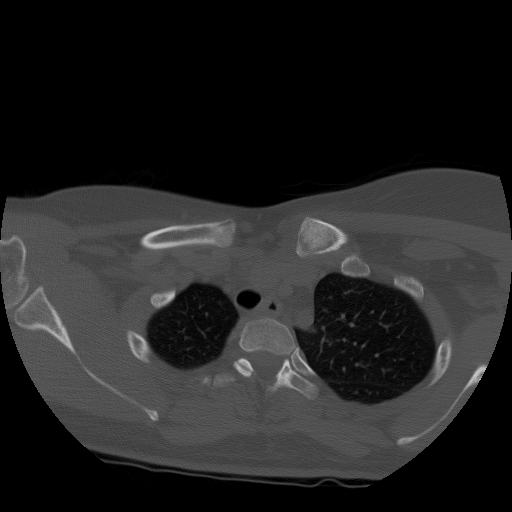 Condensing Osteitis CT 2